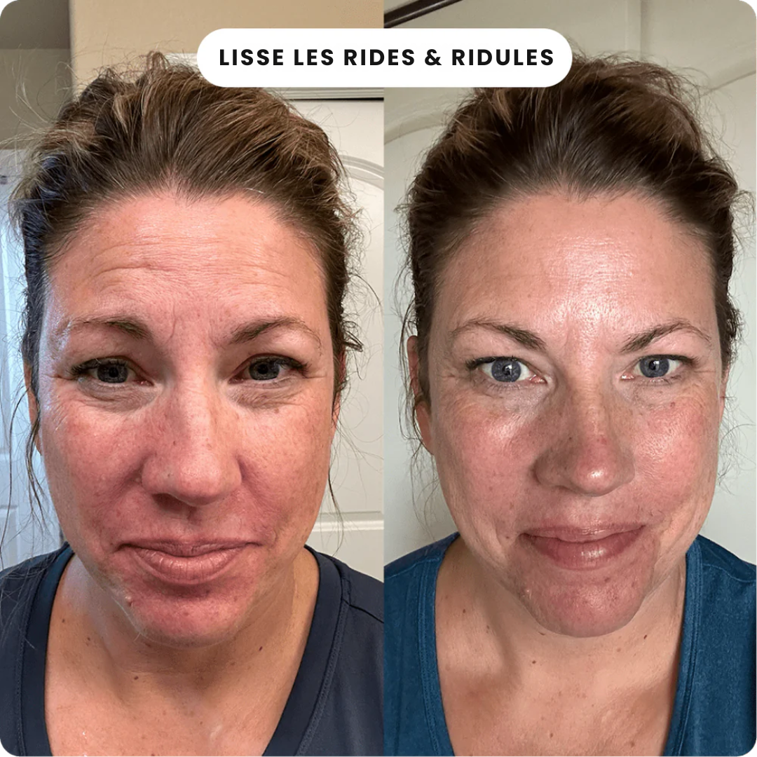 Micro Infusion Anti Âge